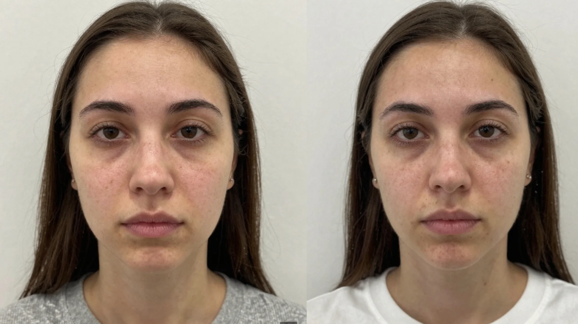 Before and after buccal massage - client 1