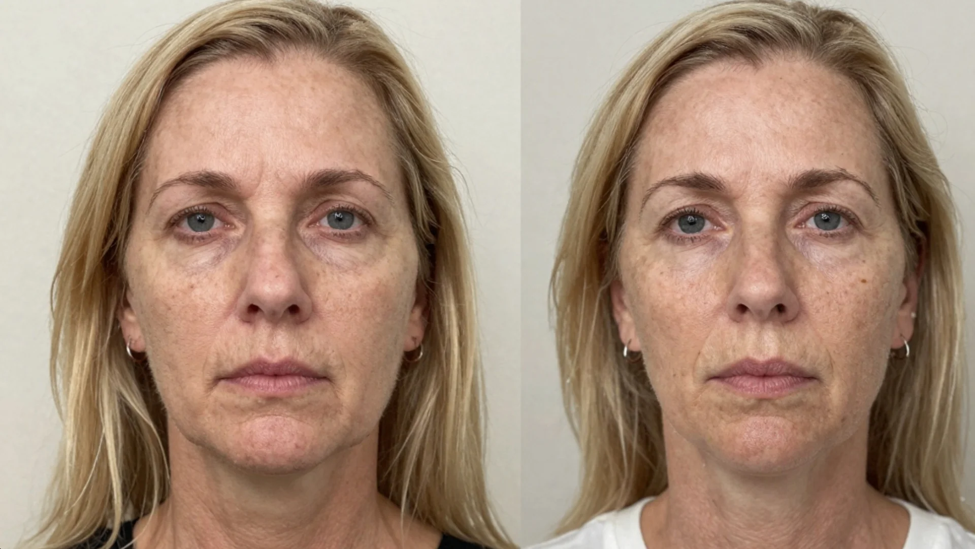 Before and after buccal massage - client 4