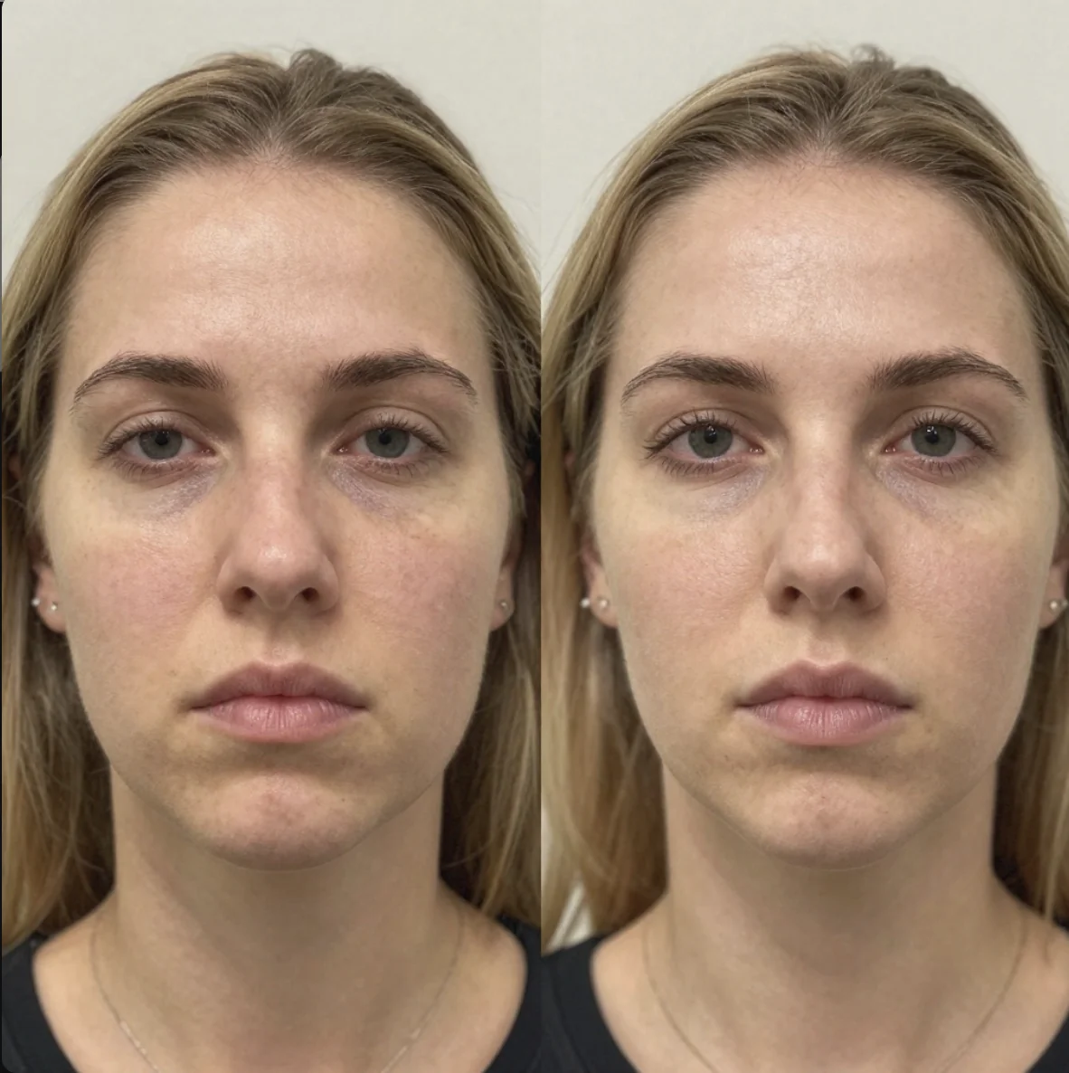 Before and after buccal massage - client 5