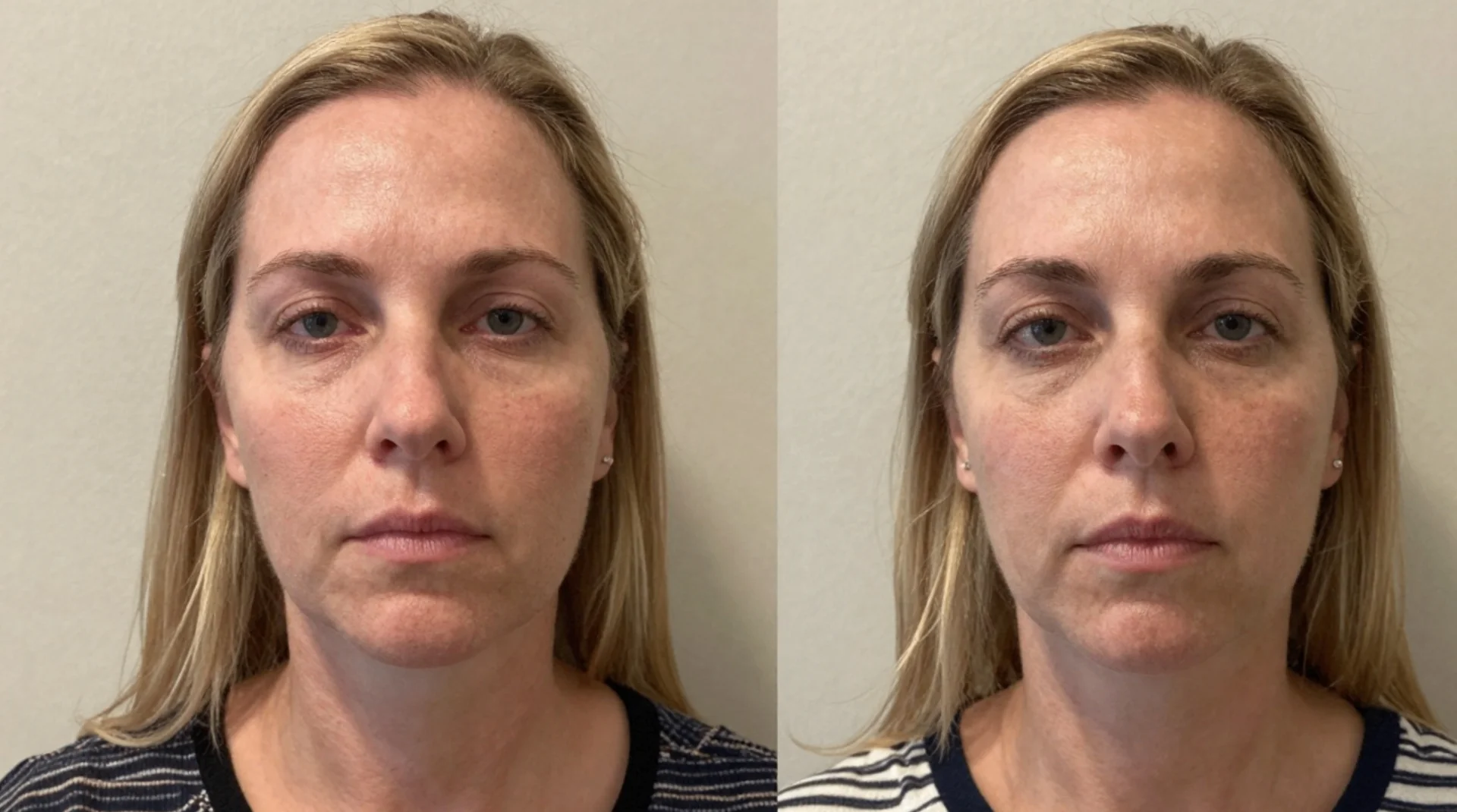 Before and after buccal massage - client 6