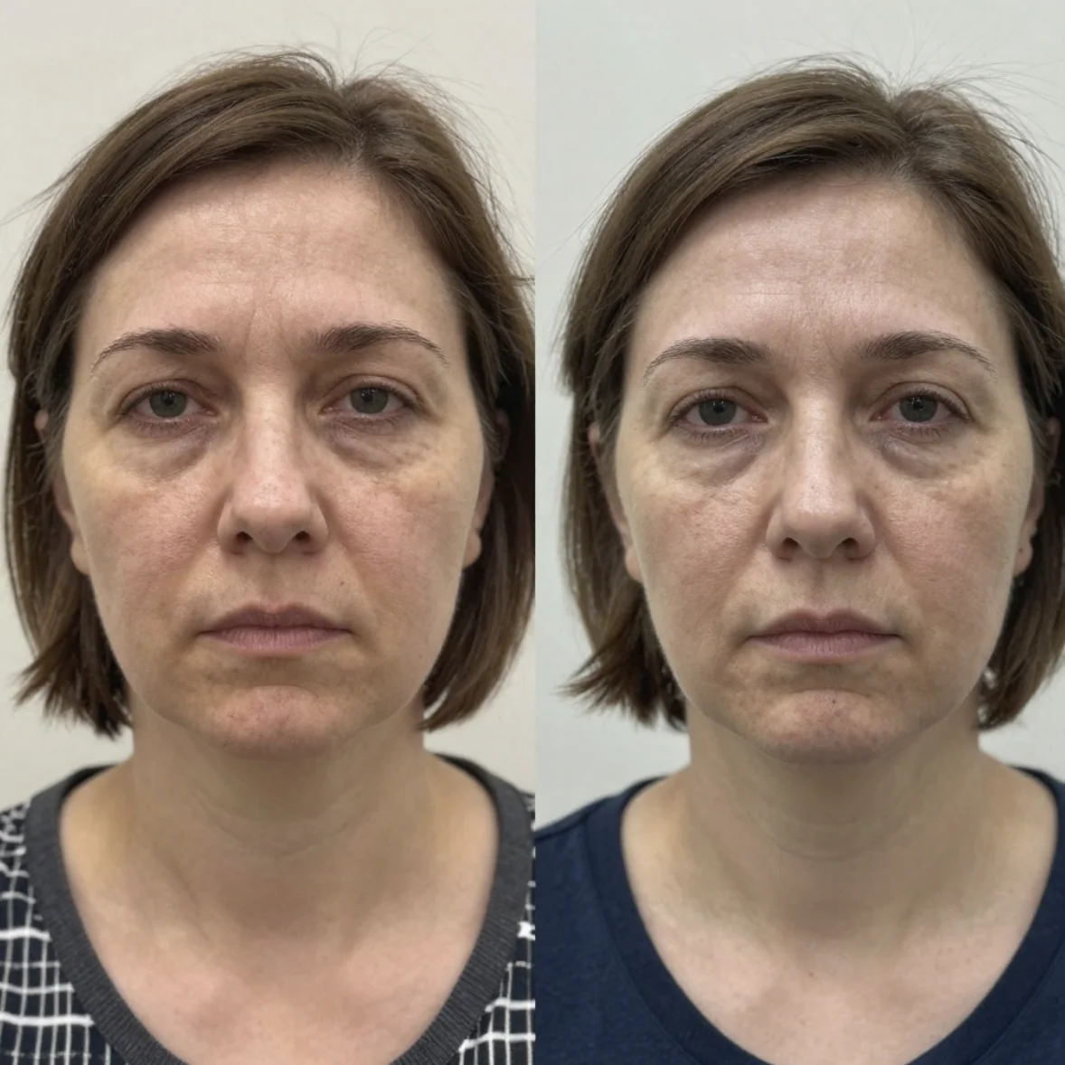 Before and after buccal massage - client 7